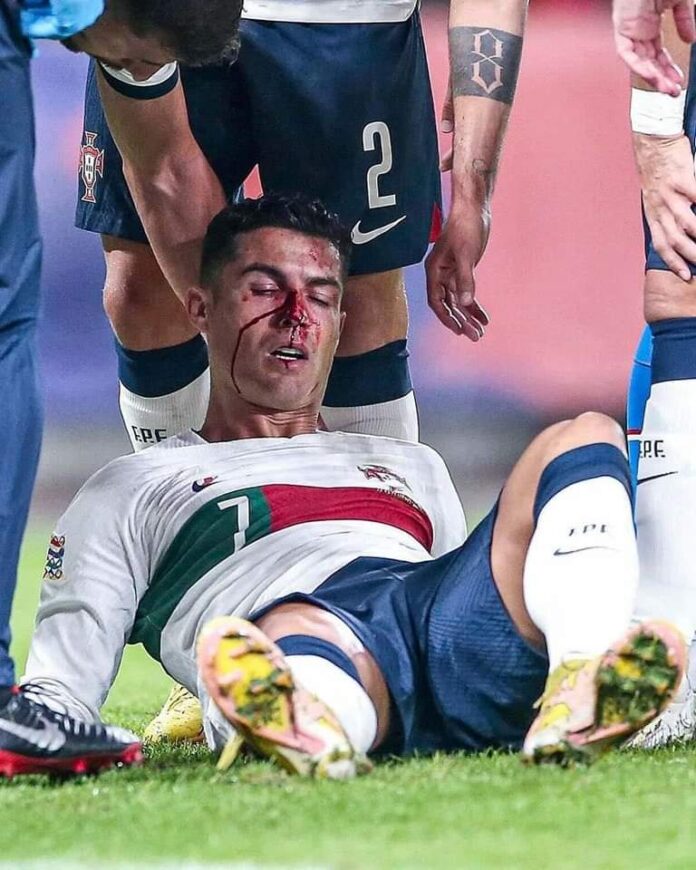 Ronaldo nasty injury